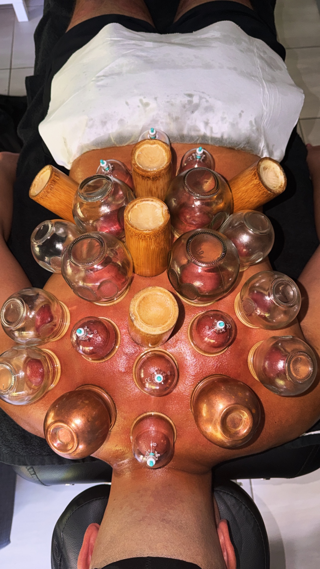 Cupping Therapy